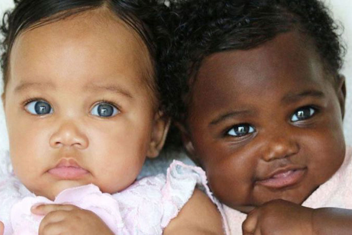 Gémeas nascem com cores de pele diferentes e transformam-se num fenómeno!