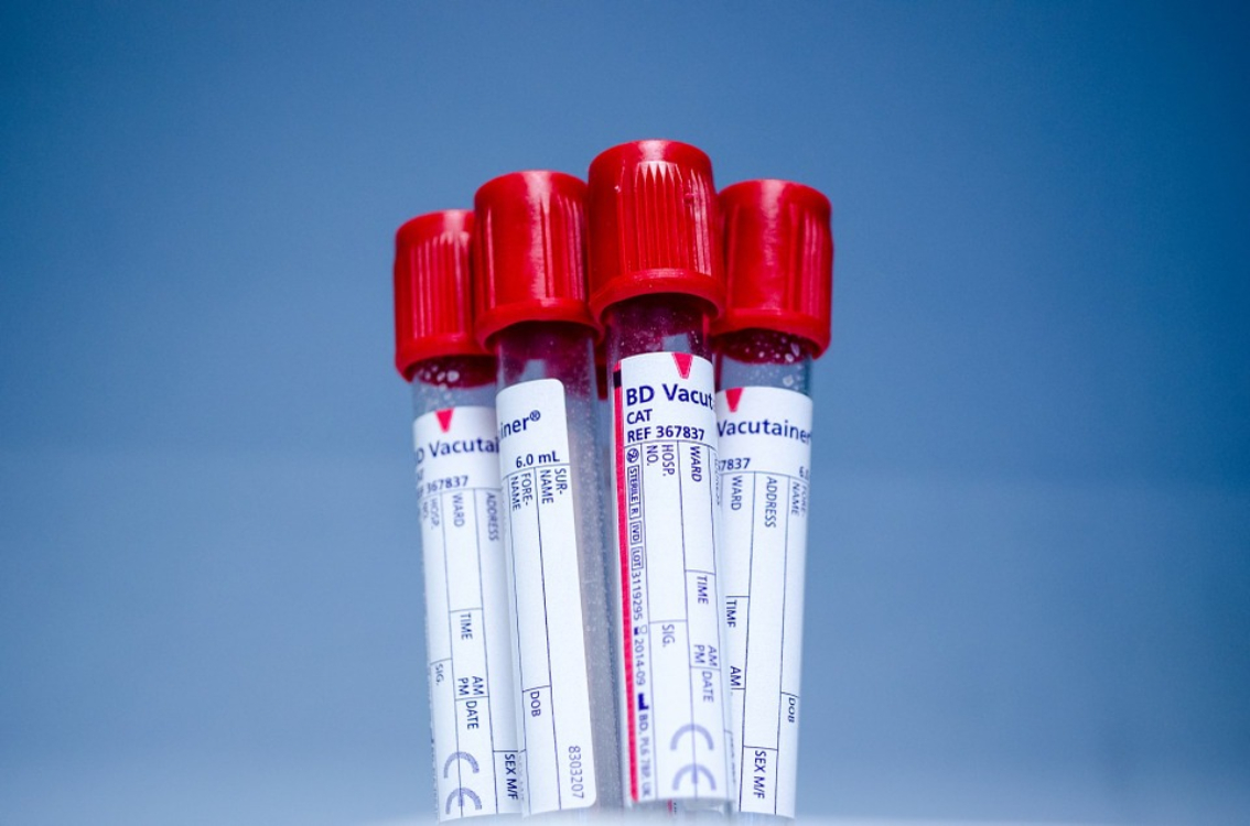 Exame de sangue deteta qualquer cancro dez anos antes de a doença se manifestar!