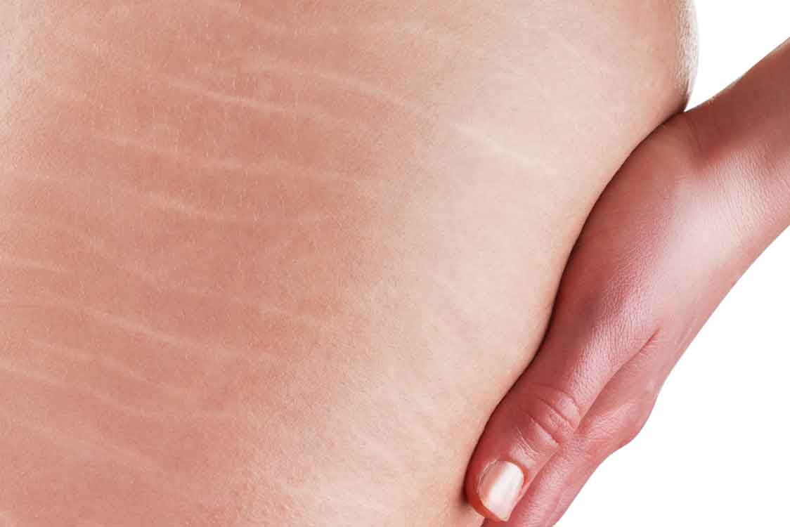 Truques para disfarçar as estrias